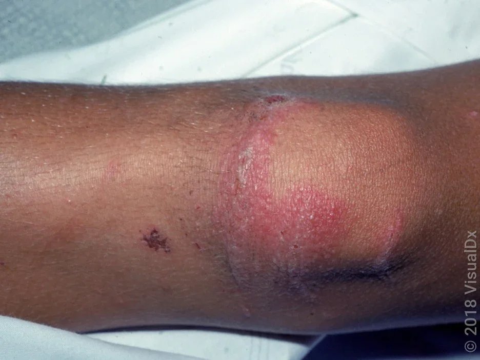 Close-up of a knee with purple and red, round, and linear patches with tiny blisters in poison ivy. 