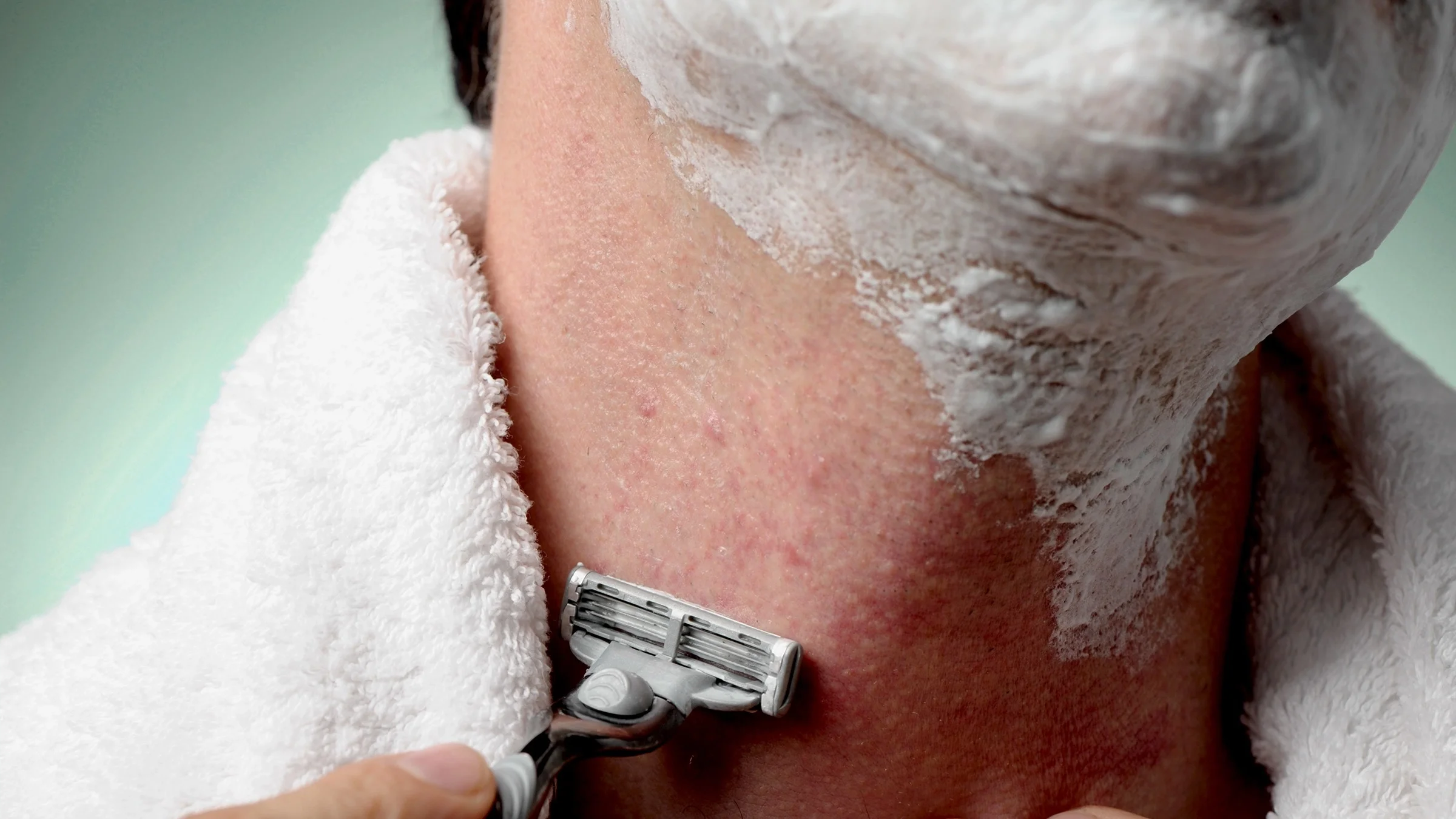 Close-up of a man shaving with a multi-blade razor. You can see red, raised razor burn bumps on his neck.