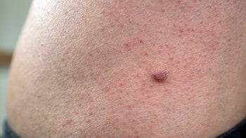 Dermatology: closeup dermatofibroma on thigh 2200349319