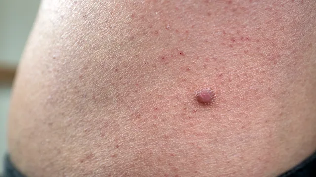 Dermatology: closeup dermatofibroma on thigh 2200349319