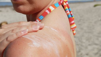 Dermatology: Skin: sunburn on beach-173919923