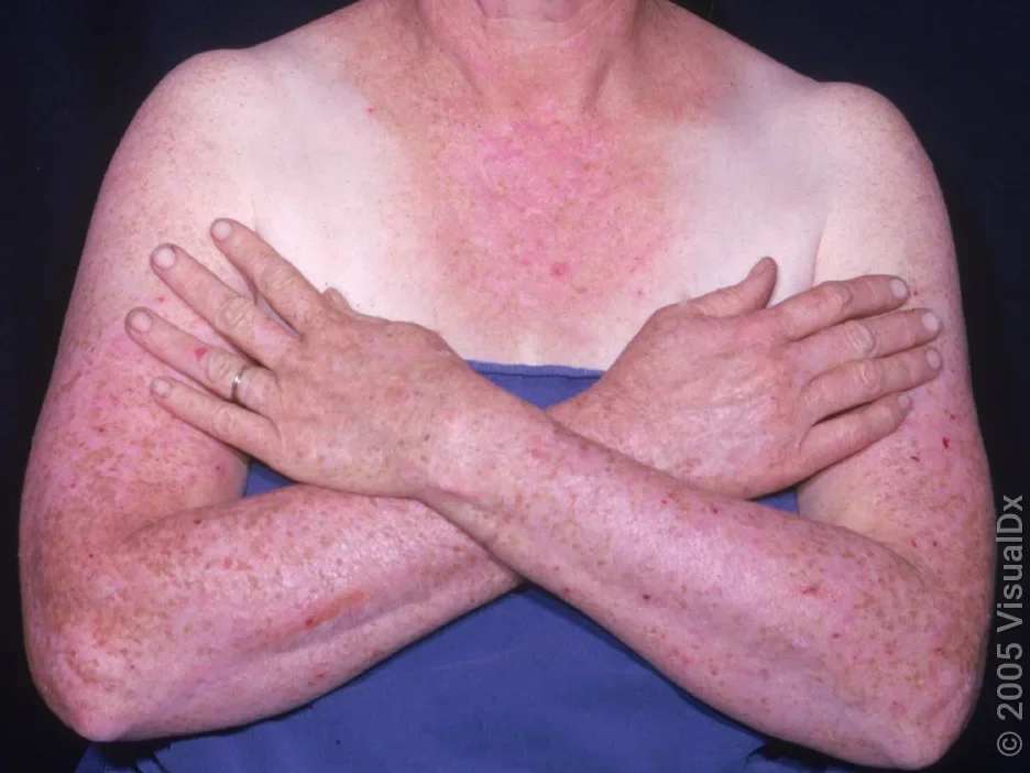Widespread pink bumps and patches on the arms, chest, and hands.