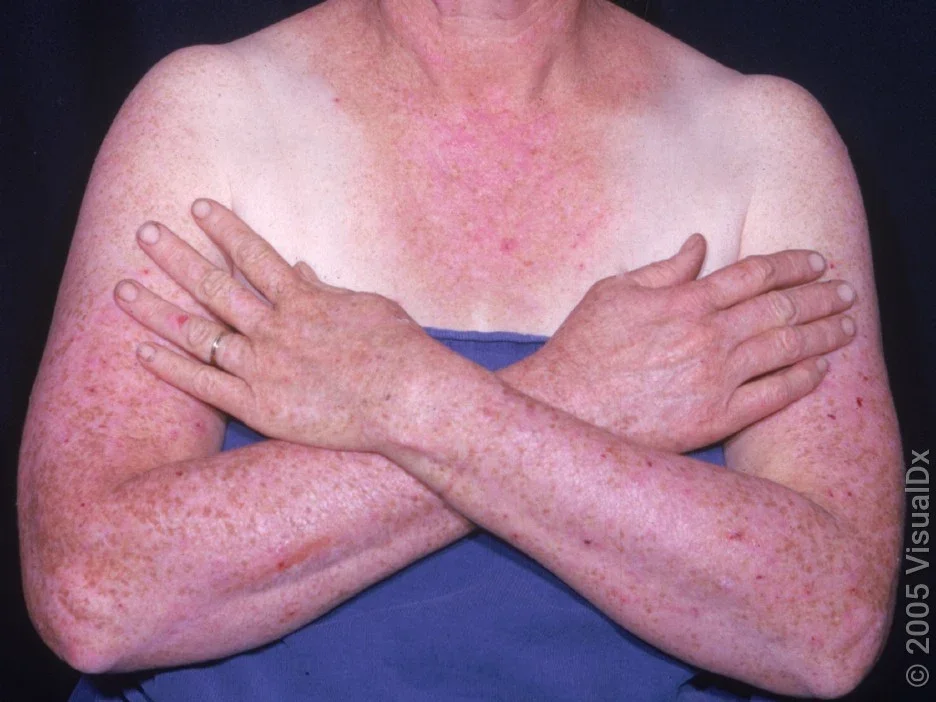 Widespread pink bumps and patches on the arms, chest, and hands.