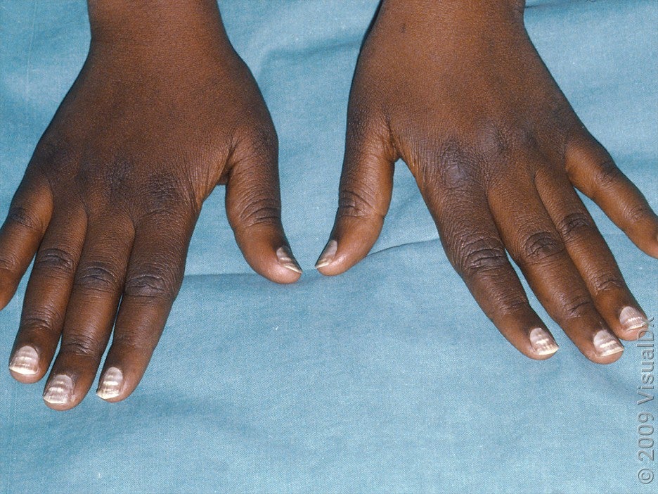 5 Signs of Vitamin Deficiency in Nails - GoodRx