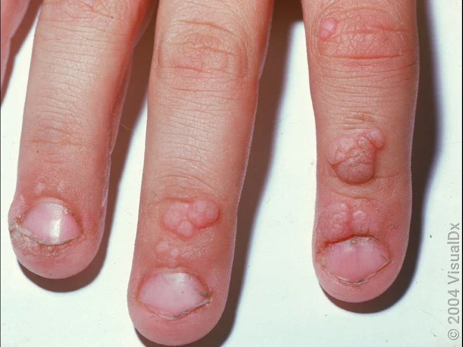 Common warts can grow around and under the nails.