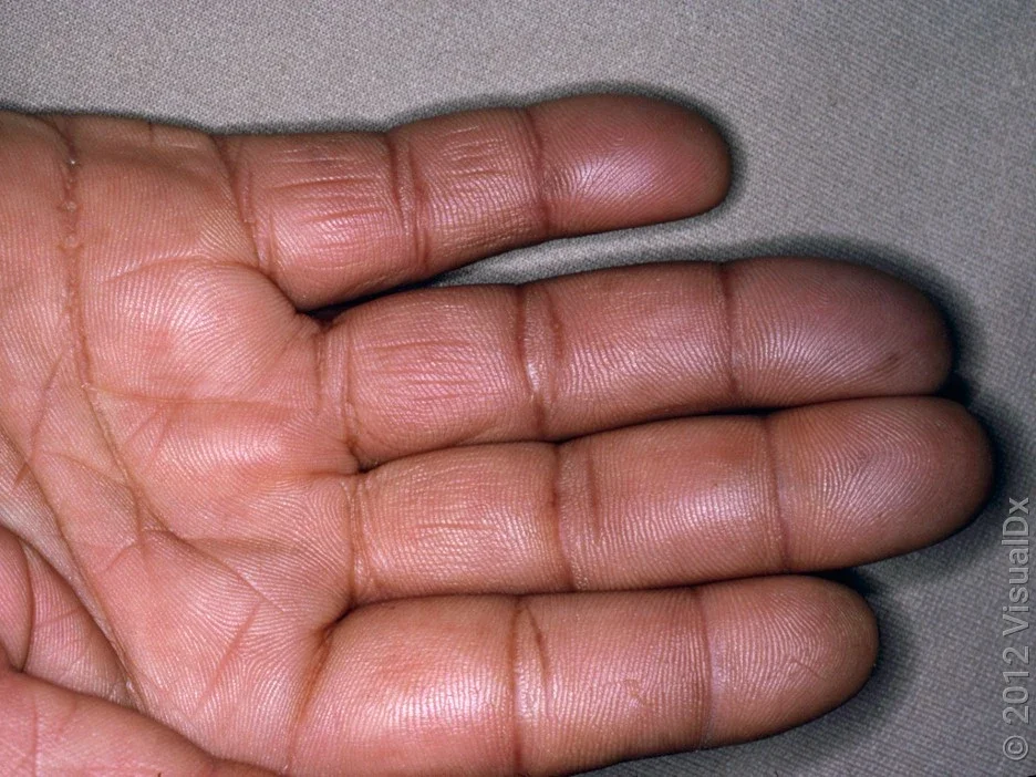 Close-up of Raynaud’s syndrome on the fingers. 