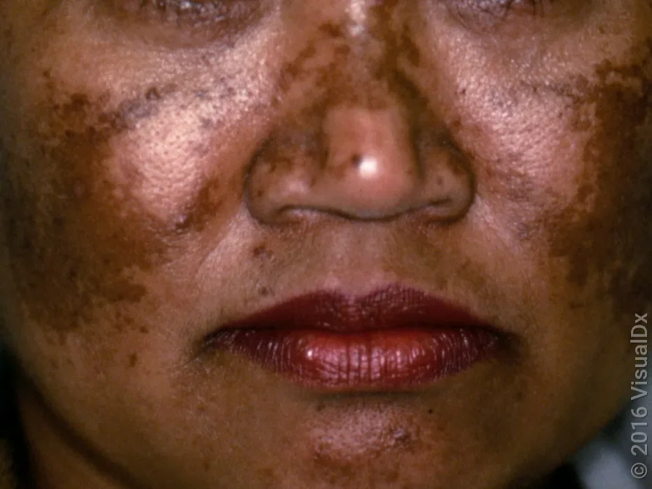 Close-up look of melasma on the cheeks, nose, and chin.