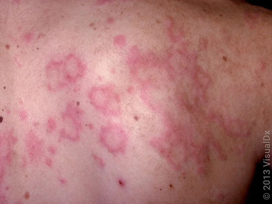 Large hives on the back.