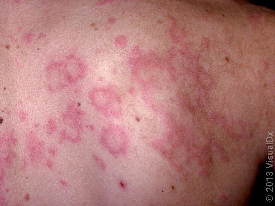 Large hives on the back. 