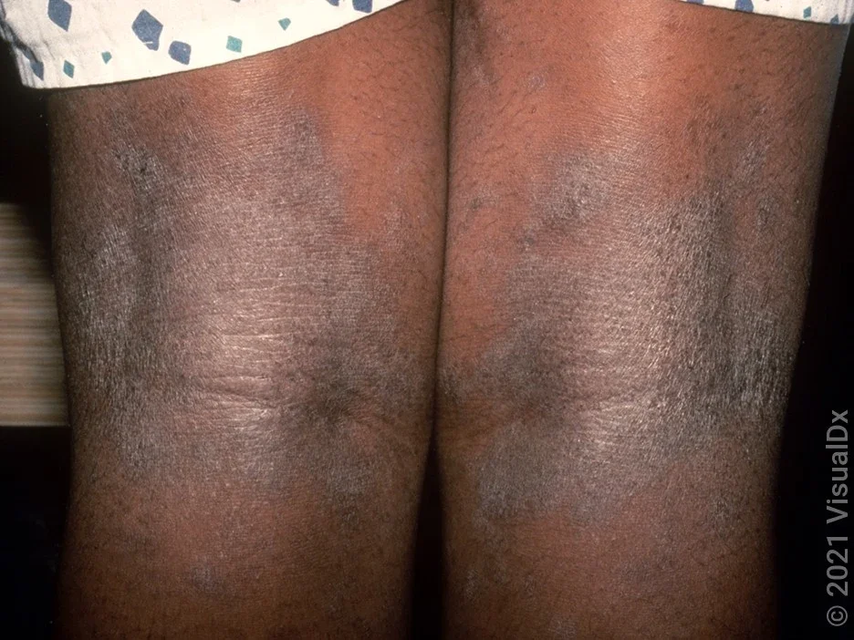 The skin behind the knees with dark brown scaly patches in eczema.