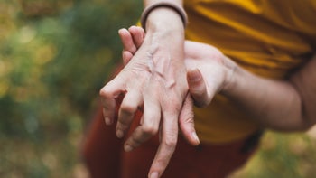 Rheumatoid arthritis: massaging arthritic hand 1204788026