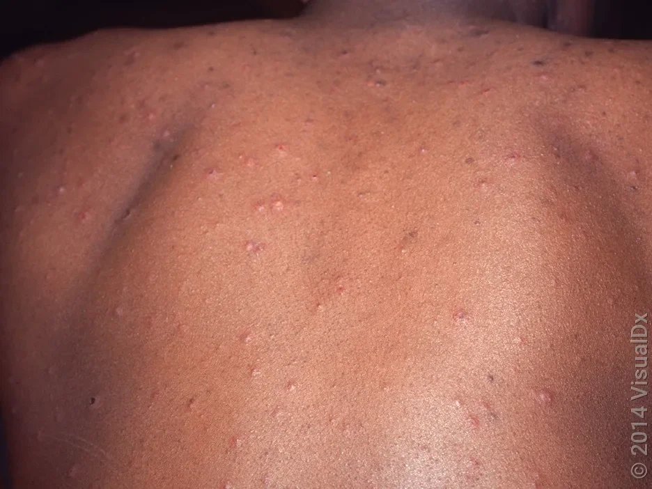 Chickenpox bumps and blisters on a person’s back.