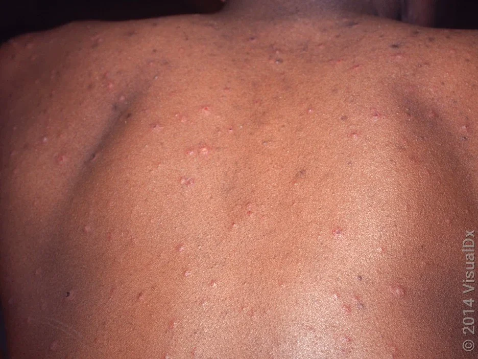 Chickenpox bumps and blisters on a person’s back. 