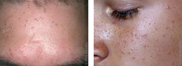 Different Types of Acne and Treatment With Pictures GoodRx