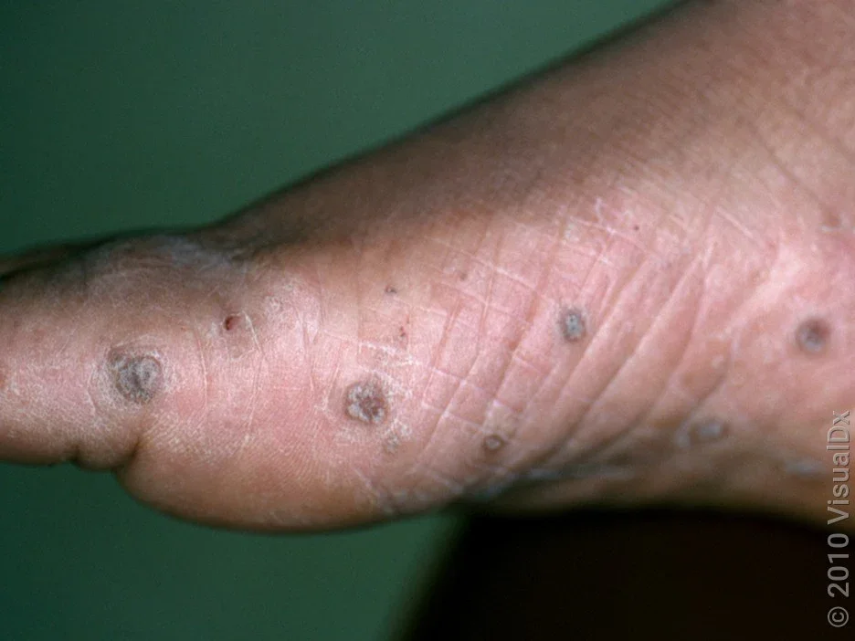 Several plantar warts on the foot. 
