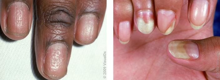 Left: Close up of fingernails with many tiny dents (nail psoriasis). Right: Close-up of discolored fingernails with white and yellow-pink patches (nail psoriasis). 