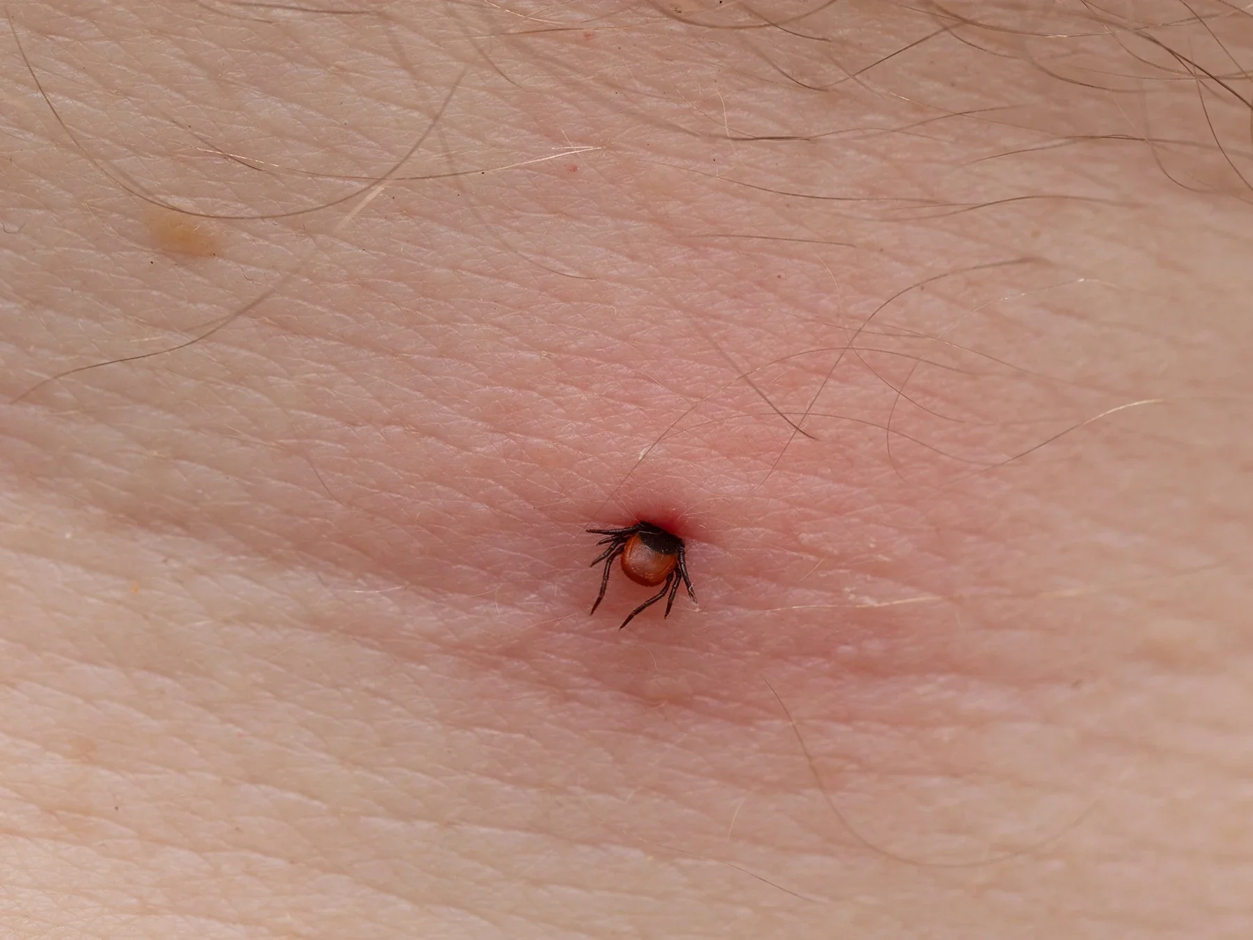 This tick’s head has burrowed into the skin, with its body and legs out of the skin.