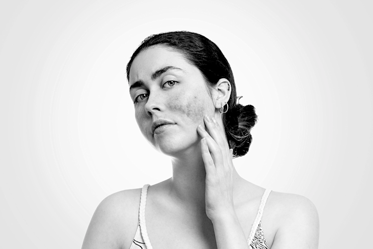 Lupus Rashes (With Pictures): What It Is and How to Treat It - GoodRx