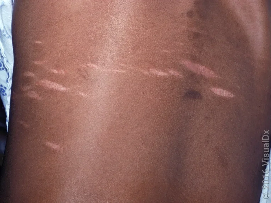 A close-up of pink stretch marks on the back.