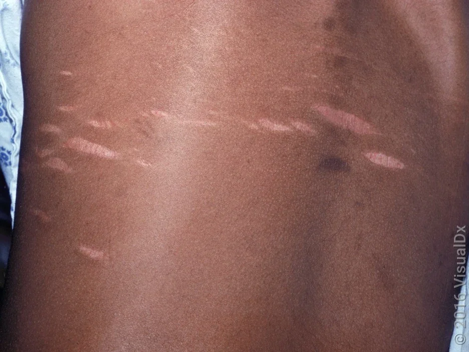 A close-up of pink stretch marks on the back.