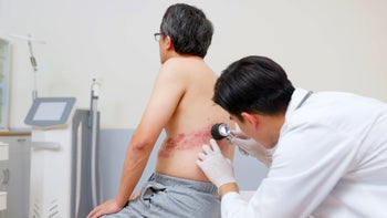Shingles: doctor examining patient with shingles 1524570203