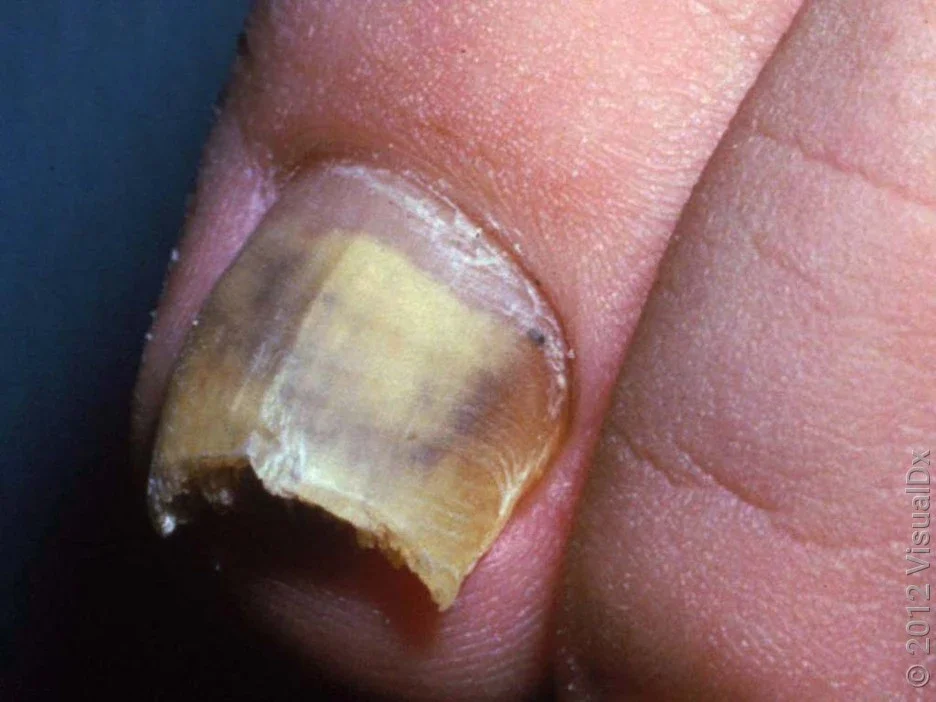 Yellow discoloration from nail fungus.