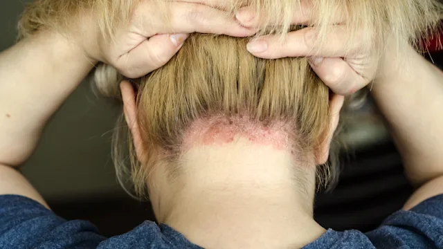 Psoriasis: psoriasis on nape of womans neck 1168357637(1)