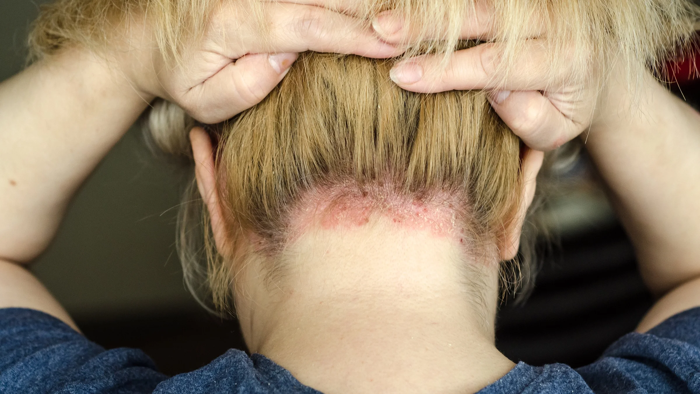 Psoriasis on the nape of a woman's neck.