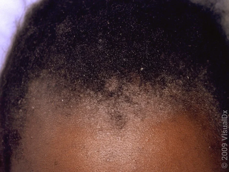 Psoriasis on the scalp in darker skin tones.