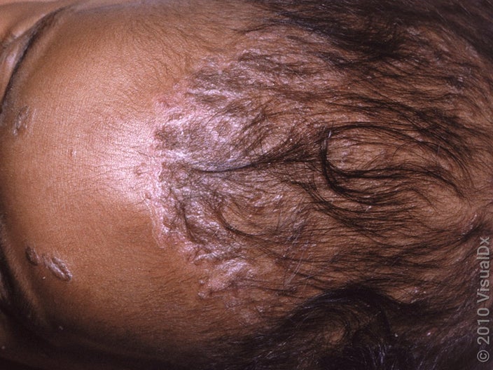 Close-up of cradle cap in an infant. 