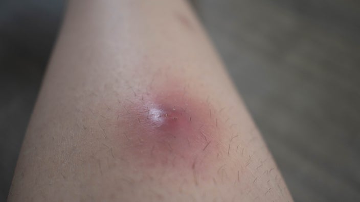 A close-up on a swollen abscess on someone’s limb.