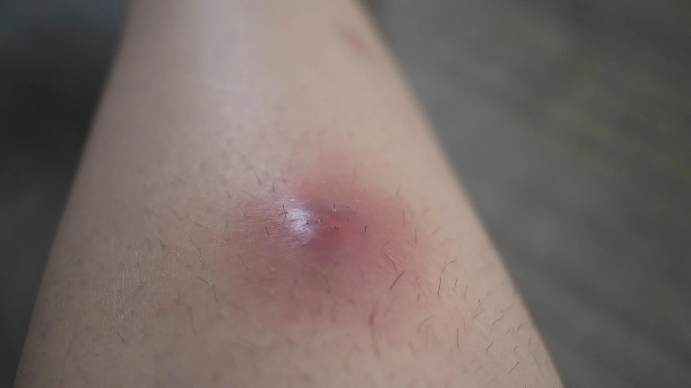 A close-up on a swollen abscess on someone’s limb.
Kara Knight/iStock via Getty Images