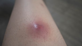 Health: Infections: infected lump under skin 1398776743