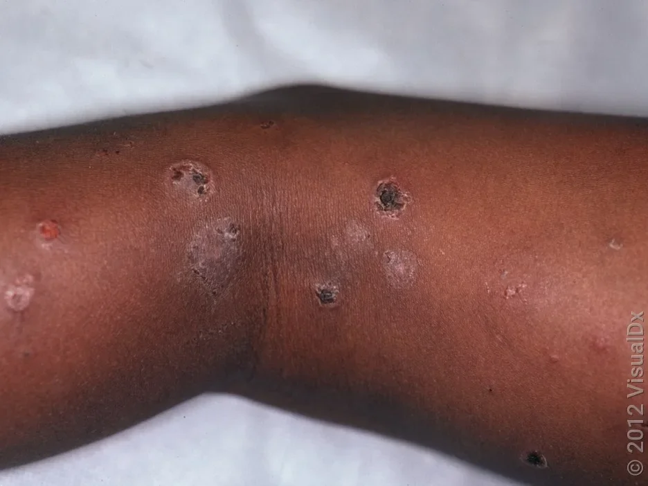Close-up of impetigo on the legs.