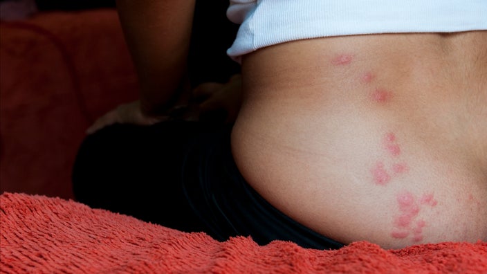 Close-up of a woman sitting on a bed with bedbug bites