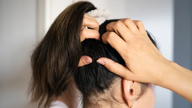 Dandruff: Seborrheic Dermatitis: backview of woman scratching scalp 1431578149