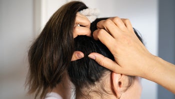 Dandruff: Seborrheic Dermatitis: backview of woman scratching scalp 1431578149