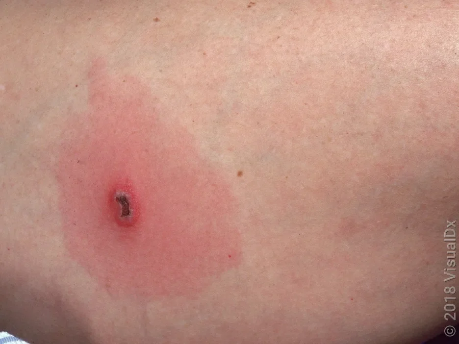 Close-up of a spider bite with a dark center bite surrounded by redness.