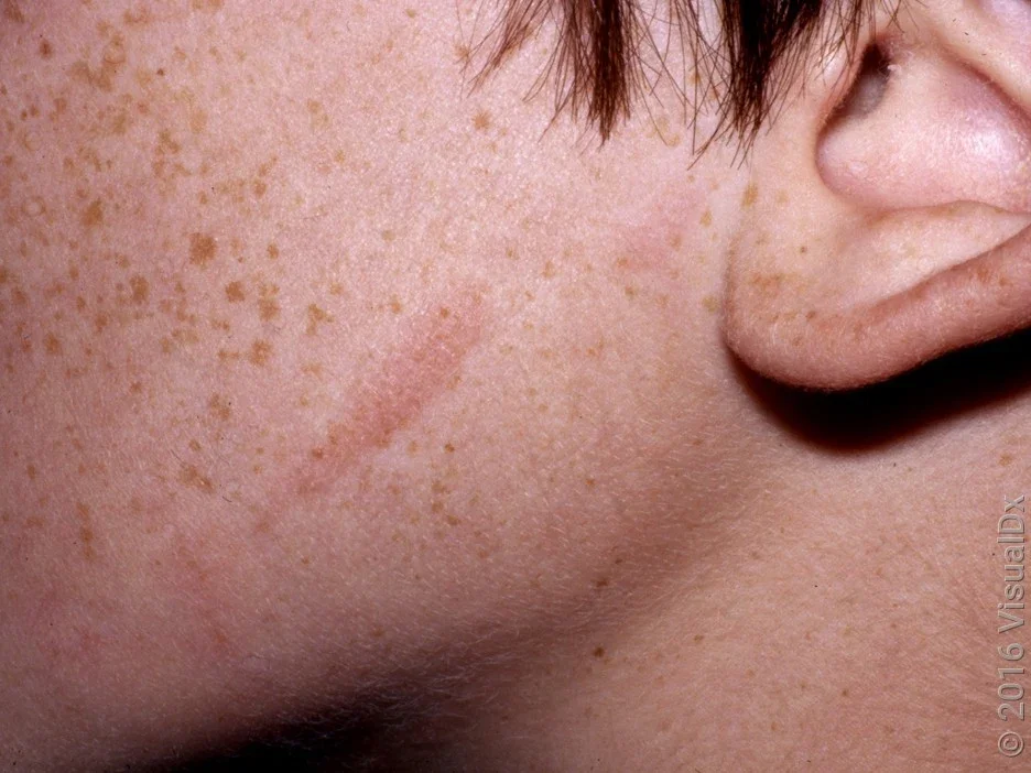 Close-up of a cheek with an early poison ivy rash. 