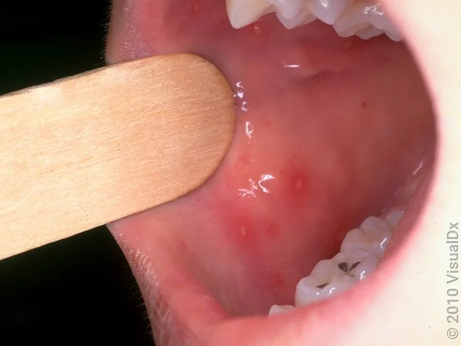 A close-up look at sores on the inside of the mouth in hand, foot, and mouth disease.