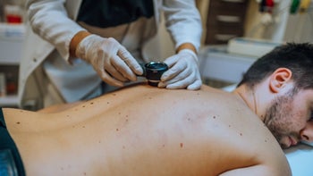 hemangioma: dermatologist examining patients skin 1432941680