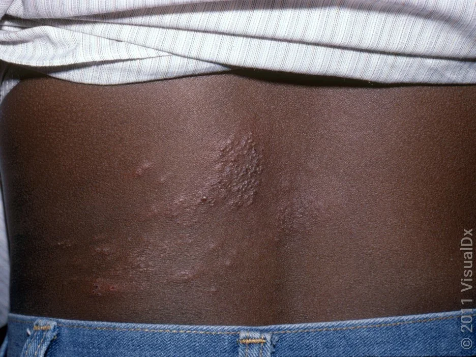 Picture of a shingles rash on the lower back. 