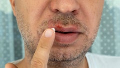 You can treat cold sores (oral herpes) with the right topicals. Explore prescription and over-the-counter herpes creams, including Abreva and Zovirax.