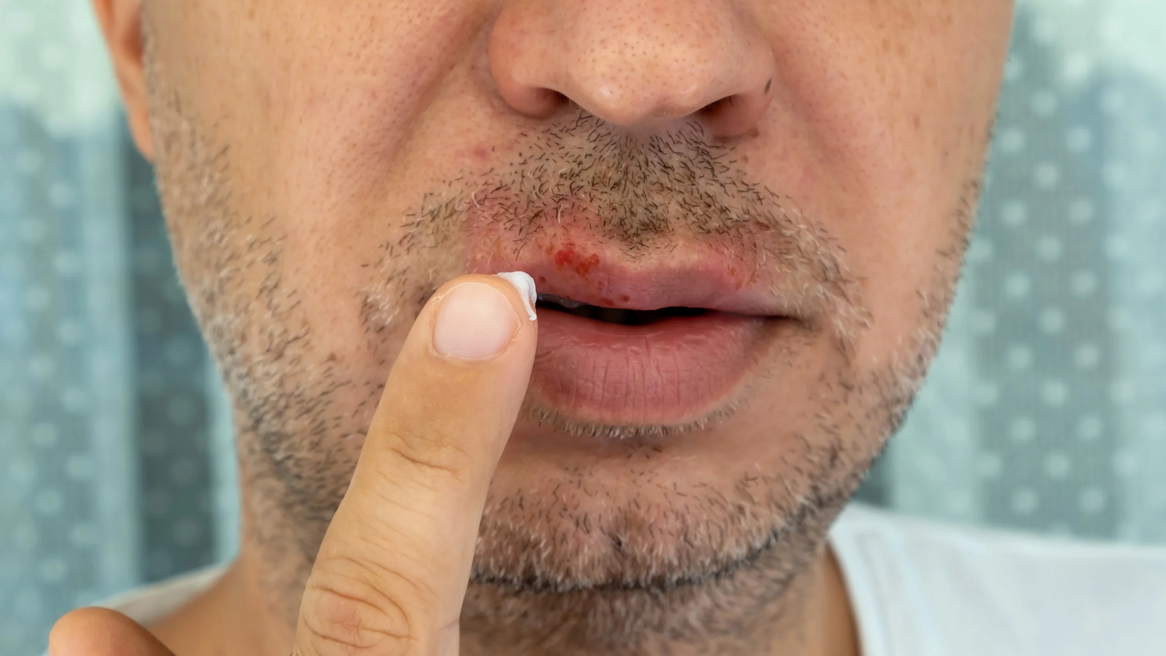 Close-up of someone applying herpes cream on lip.