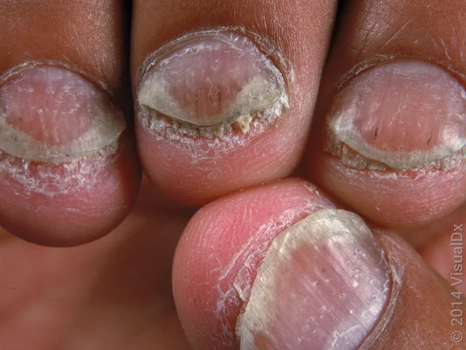 Close-up of thickened and discolored nails of a person with psoriatic arthritis.