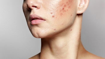 Dermatology: closeup woman with acne 1352332078