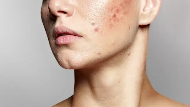 Dermatology: closeup woman with acne 1352332078