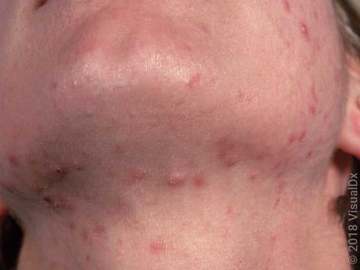 Hormonal acne on the neck and chin. 