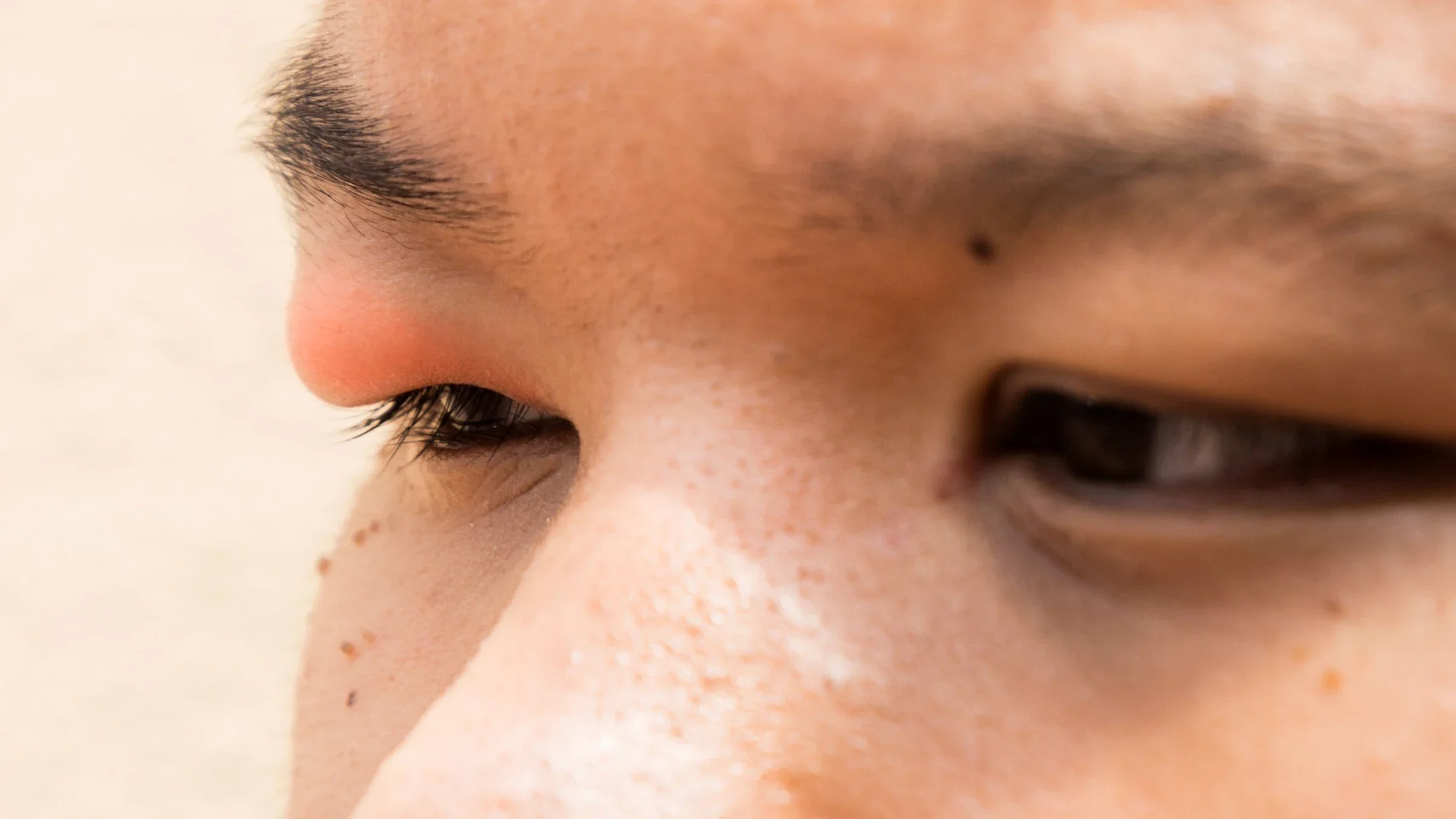 Close-up of a person with stye on their eye.
ThamKC/iStock via Getty Images Plus