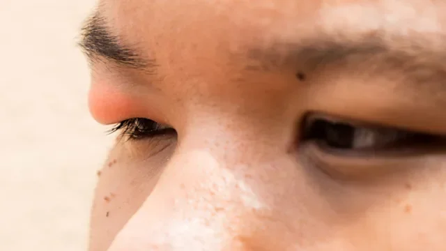 Eye pain: closeup man with stye 497348668